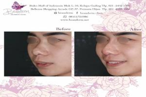 Filler Hidung / Nose Filler